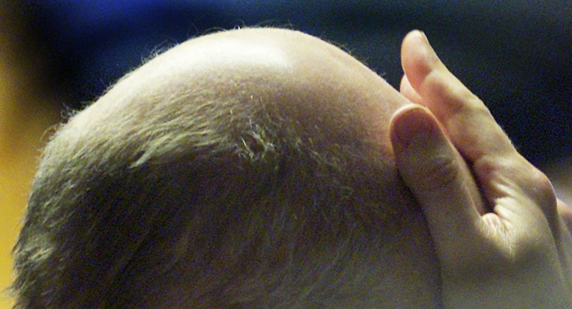 A closeup of a man's balding head with a hand held to the forehead.