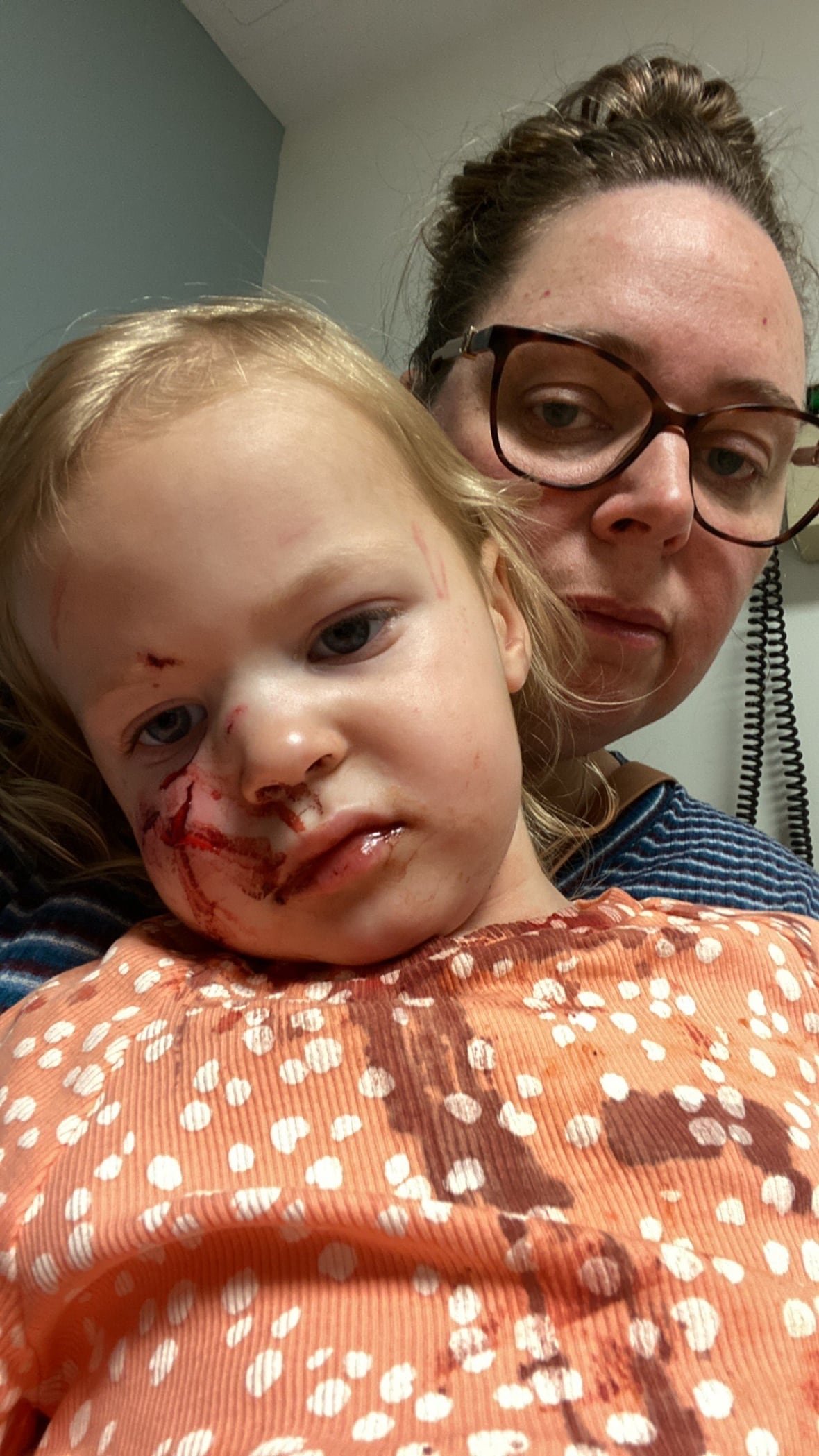 2 year old girl with swollen face wearing stained shirt.