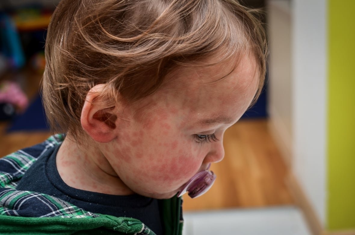 A toddler with red splotches on his skin has a soother in its mouth.