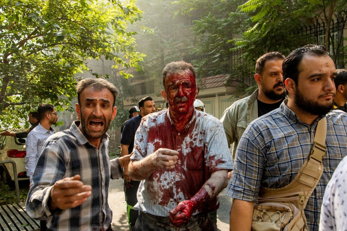   A wounded man reacts following the Israeli strikes on Iran, in Tehran, Iran, June 15, 2025. Hamid 