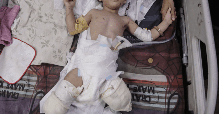 Gaza’s Vulnerable Suffer War’s Toll: Malnourished, Maimed And Displaced - Dubai News TV