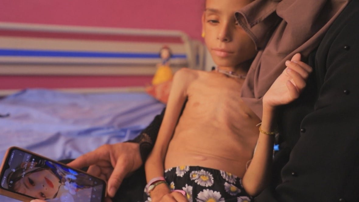A young girl who is severely malnourished sits on her mother's lap. 